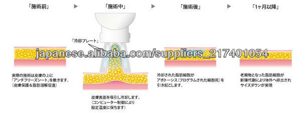 総合一体痩身機脂肪冷却+PDT+キャビテーション+RF問屋・仕入れ・卸・卸売り