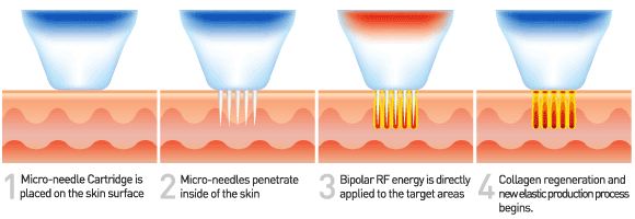 Micro-needle Fractional RF