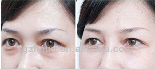 eye bag ,black circle removal.jpg