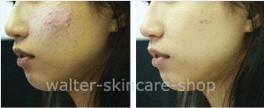 acne-removal