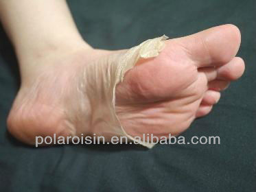 Hand Foot Mouth Disease in Adults