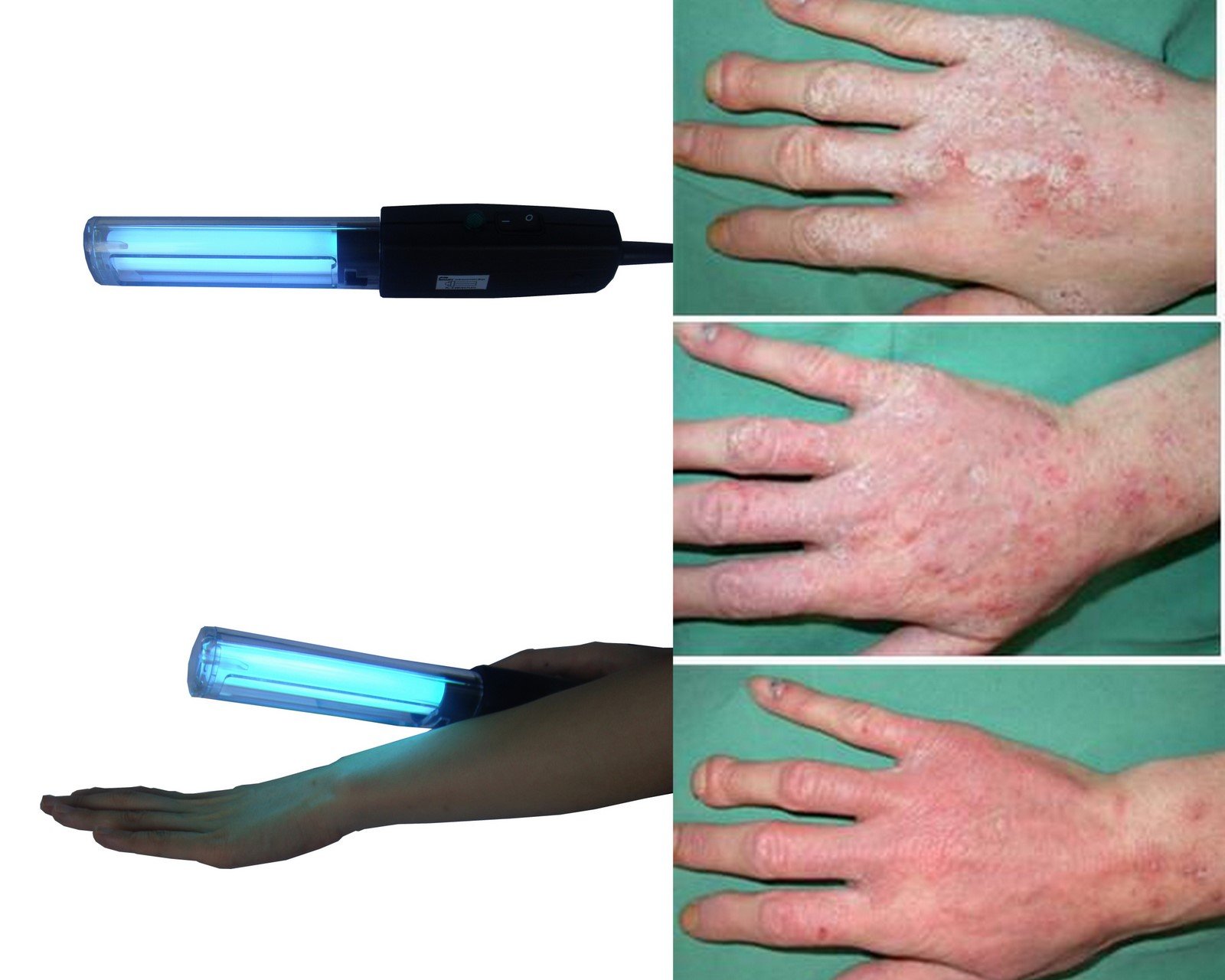 紫外線ライトの反Psoriasis、VitiligoのEczema仕入れ・メーカー・工場