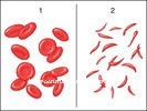 sickle cell anaemia. SICKLE CELL ANEMIA TREATMENT