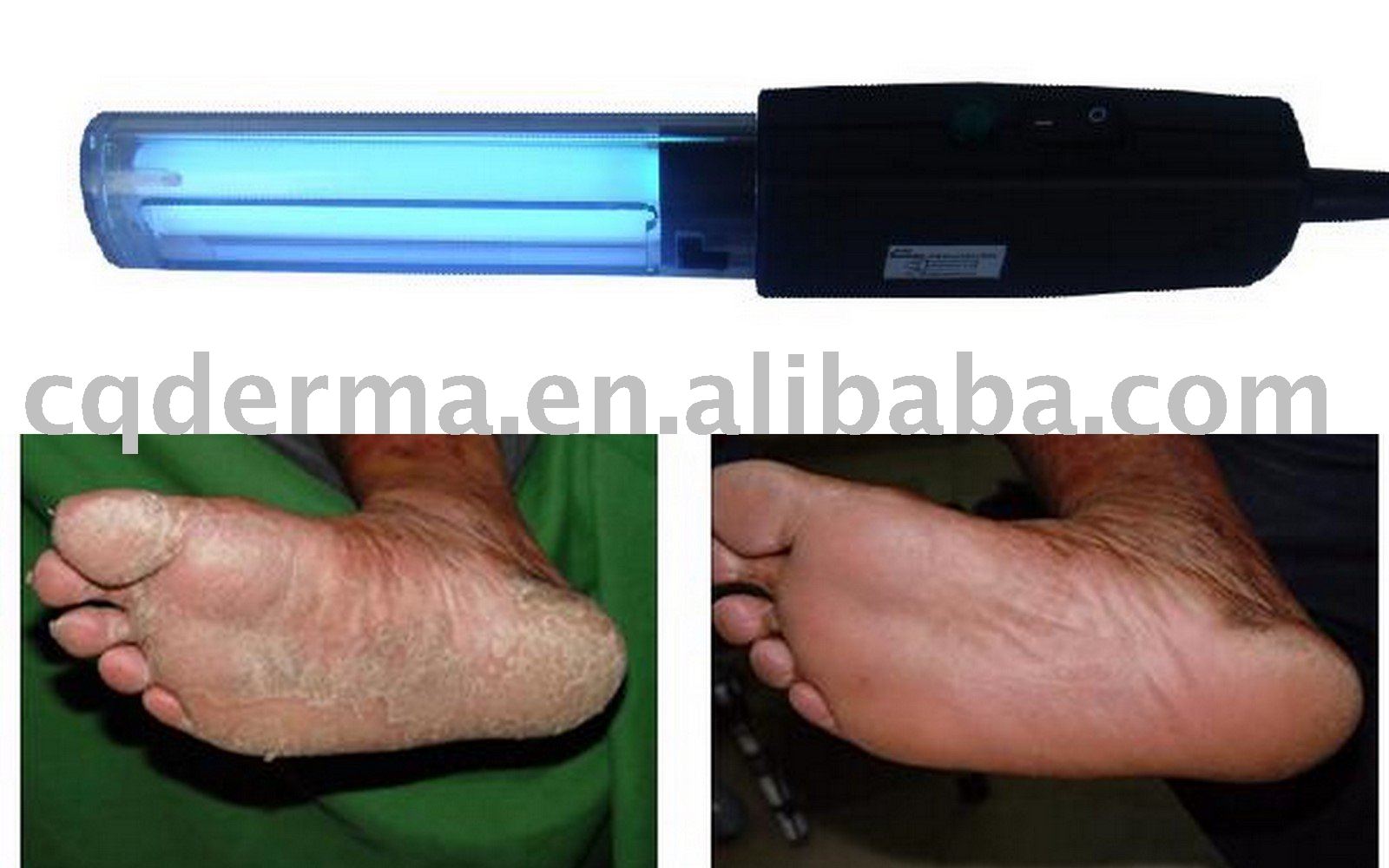 Uv nail lamp psoriasis reviews