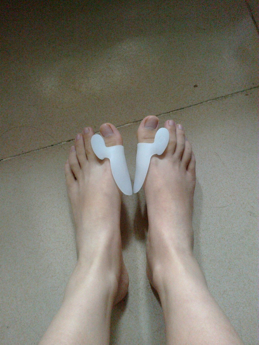 Hammer Toe