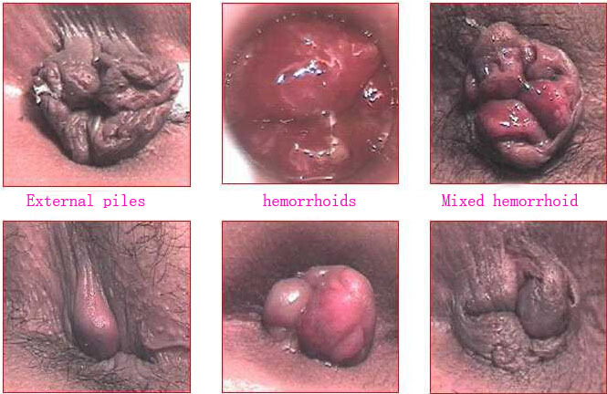 hemorrhoids definition