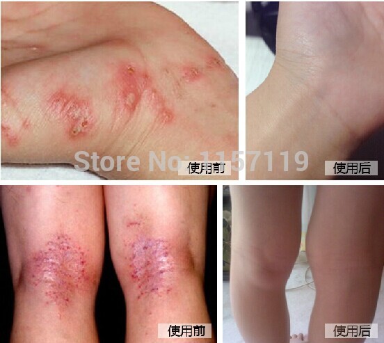 Suitable for scar cause by: Surgery, Burn, Cut, Acne, Tattoo Laser and 