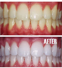 New arrive Whiten Teeth Tooth Dental Peeling Stick + 25 Pcs Eraser wholesale