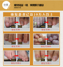 Best Quality Fungal Nail Treatment Essence Nail and Foot Whitening Toe Nail Fungus Removal Feet Care