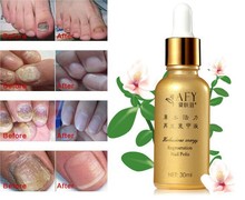 Fungal Nail Treatment Essence Nail and Foot Whitening feet care foot care Toe Nail Fungus Removal Feet Care Nail Gel 2pcs