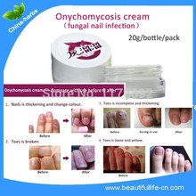 2 bottles treatment of nail fungus toenails infection to beauty nails