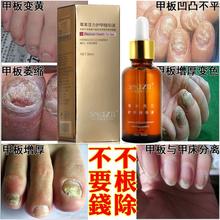 Fungal recover health to Nail onychomycosis Treatment Herbaceous energy Essence Foot Whitening Fungus Removal Care Gel