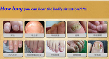 Free Shipping Fungal Nail Treatment Essence Nail and Foot Whitening Toe Nail Fungus Removal Feet Care