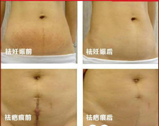 vibrationsplatte cellulite erfahrungen
