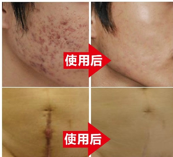 acne scar removal cream Acne Spots skin care treatment whitening face 