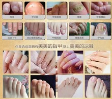 Gray toenail onychomycosis paronychia A special care of the clean natural plant repair armor drops authentic free shipping