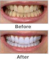 new 2014 oral hygiene Products teeth whitening teeth whitening pen for personal care as seen tv